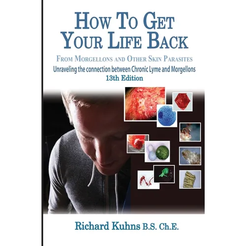 How to Get Your Life Back From Morgellons and Other Skin Parasites Limited Edit